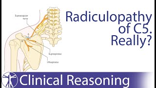 Suprascapular Nerve Entrapment mimicking C5 Radiculopathy [upl. by Aibos]