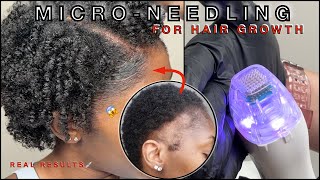 MICRONEEDLING  PRP FOR EDGE GROWTH 💉 FULL PROFESSIONAL JOURNEY  TRACTION ALOPECIA 🚨  FAQ [upl. by Imaon]