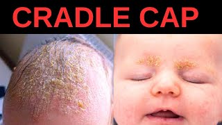 What is Cradle Cap Symptoms Causes Treatment [upl. by Olegnaid838]