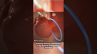 Endoloop Assisted Colonoscopic Polyp Removal Polypectomy Technique [upl. by Donovan]