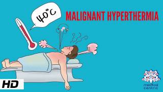 MALIGNANT HYPERTHERMIA Causes Signs and Symptoms Diagnosis and Treatment [upl. by Bachman]