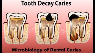 Histopathology of dental caries Functions of saliva [upl. by Sidoeht]