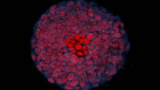 Cancer cells in 3D cell culture breast adenocarcinoma [upl. by Cummine518]