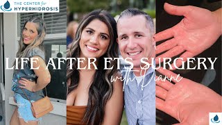 Life after ETS Surgery with Dianne  Palmar Hyperhidrosis [upl. by Oigimer]