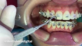 Colocación de Brackets y Retiro de Excesos de Pegante  Video Corto [upl. by Philis175]