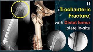 IT Trochanteric Fracture with Distal Femur Plate in Situ [upl. by Amikat]