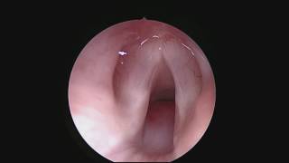 Subglottic Hemangioma [upl. by Lowney]