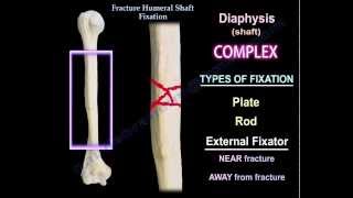 Humeral Shaft fracture Fixation  Everything You Need To Know  Dr Nabil Ebraheim [upl. by Ecirahc]