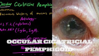 Ocular Cicatricial Pemphigoid  mucous membranous pemphigoid [upl. by Tracy]