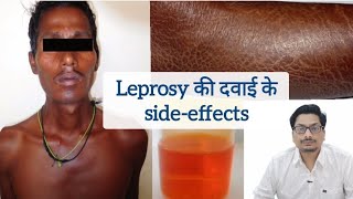 Leprosy की दवाई के sideeffects  Clofazimine  Hansepran  Rifampicin leprosy clofazimine कुष्ट [upl. by Alyakam]