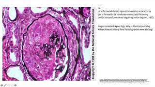 Glomerulopatias [upl. by Vtarj]