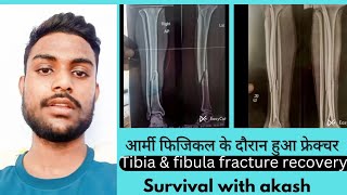 Army physical test time Tibia and fibula fracture l 80 days after fracture recovery video l [upl. by Yezdnil472]