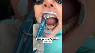 Step by step porcelain veneer makeover ❤️ [upl. by Laemaj]