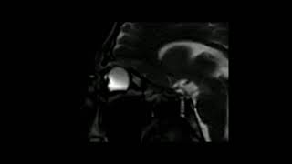 Imaged impact eye rubbing MRI [upl. by Lud]