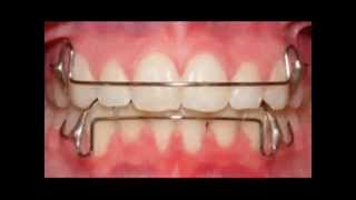 Retainers After Braces  Types Of Retainers After Braces [upl. by Neehar]