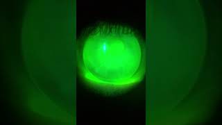 Bifocal Gas Permeable Contact Lens [upl. by Yragerg]