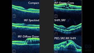 Macular OCT Interpretation A Practical Discussion with Dr David E Lederer [upl. by Certie]