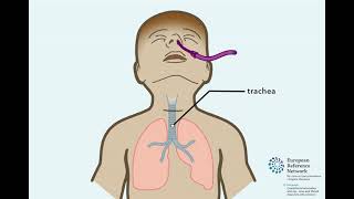 Tracheotomie bij kinderen in het Nederlands [upl. by Ahtnicaj118]