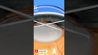 Cataract Explained  Everything you need to know [upl. by Cummins]