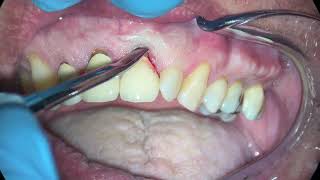 Anterior Incisor Extraction Due to Persistent Apical Periodontitis [upl. by Fausta]