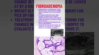 Fibroadenoma pathologyacademy draditikumar mbbs neet neetpg [upl. by Serilda79]