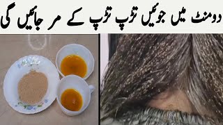 lice removal home remedies  Anti lice treatment at home  lice removal in urdu  lice lice removal [upl. by Depoliti]