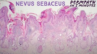 Nevus sebaceus Dermpath in 5 Minutes pathology dermatology dermatopathology [upl. by Ennybor361]