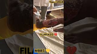 🧑🏻‍🔬FILARIASIS 💔mbbsdoctorfilariasisjoharimbbsneetmbbmbbsdairiesdiseasecancerlifestylepw🪷 [upl. by Pelaga]