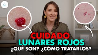 🔴 ATENCION Si tienes LUNARES ROJOS haz ESTO drapilarochoa  Dermatologa [upl. by Norval]