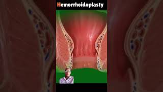 remove hemorrhoids laser 3danimationsurgery crazypharmaguruji1331 goodtoknow [upl. by Timmi]