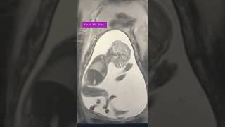 Fetal MRI scan Pregnancy Parenting Mother Baby Ultrasound প্রেগন্যান্সি Anomaly scan Women health [upl. by Rubenstein]