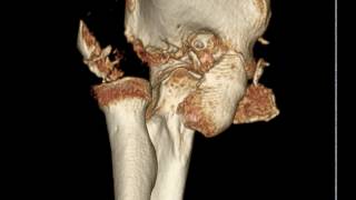 Elbow fracture dislocation  Humerus intercondylar fracture [upl. by Eityak102]