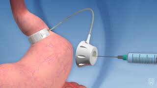 Laparoscopic adjustable gastric banding [upl. by Canice]