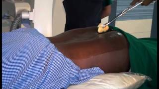 CAUDAL EPIDURAL INJECTION VIDEO  By Dr Vicky Nevagi Pain clinic of India Goa Branch [upl. by Mark]