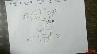 Upper and lower motor neuron type of facial palsy [upl. by Allenotna]