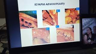 Preprosthetic surgery lecture part 1 [upl. by Apollus]