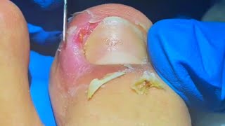 Best Techniques for Removing Seriously Infected Ingrown Toenails [upl. by Olwen640]