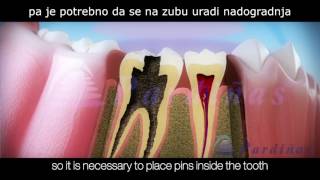 endodoncija  postupak lecenja zuba [upl. by Acirre]