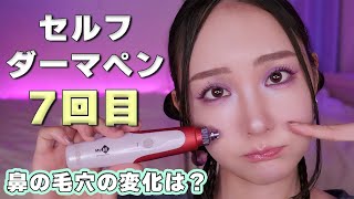 【セルフダーマペン】7回目👃鼻の毛穴の効果は？BeforeAfter約2週間高画質で35歳の肌比較◎【正直レビュー】 [upl. by Azaria]