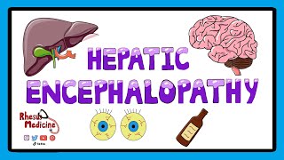 Hepatic Encephalopathy  Pathophysiology Stages and West Haven Criteria [upl. by Art998]