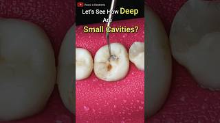 Tooth cavity  How to prepare tooth before filling dentaldoubts passiondentistry dentist [upl. by Lorien]