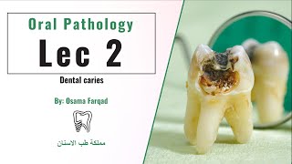 Oral Pathology Dental caries  اورل باثو المحاضرة الثانية [upl. by Rutherford896]