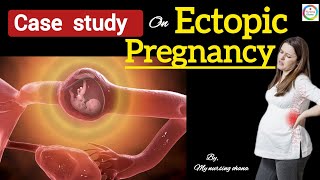 Case study on Ectopic pregnancy in OBGNursing767 casestudy nursingstudentimportant topic⚕️ [upl. by Kenlay]