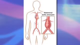 What is an abdominal aortic aneurysm [upl. by Madden]