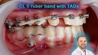 TADs for retruded mandible treatment use of the mini implants to advance the lower jaw for cl II [upl. by Adlar]