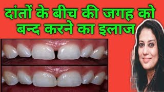 दांतों के बीच में गैप को बंद करने का ईलाजTreatment Of Midline Diastema by Braces [upl. by Jody191]