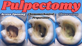 Pulpectomy ⚪️ PRIMARY MAXILLARY MOLAR 🟡 4 Canals 🔵 step by step demonstration [upl. by Eniarrol]