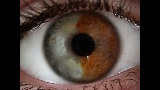 Cataract Surgery in Sectoral Heterochromia Iridis [upl. by O'Neil]