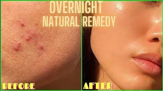 HOW TO GET RID OF ACNE PIMPLES BUMPS ON FACE OVERNIGHT  Simple Home Remedy DIY Lemon Treatment [upl. by Imena]