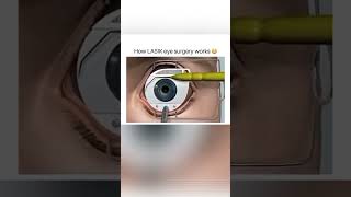 How LASIK eyes surgery works short [upl. by Nosde]